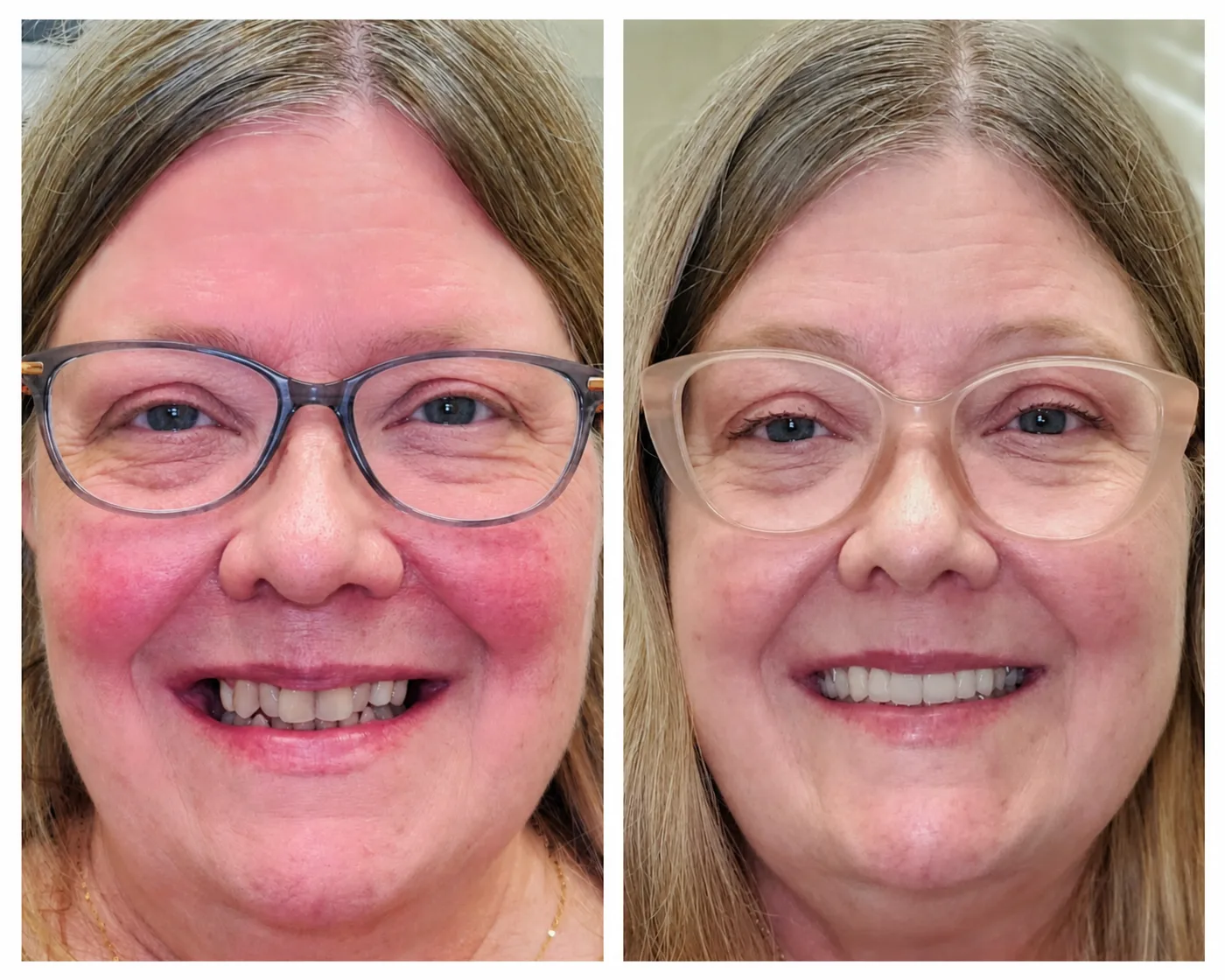 Cosmetic dentistry before and after result in Killeen, TX